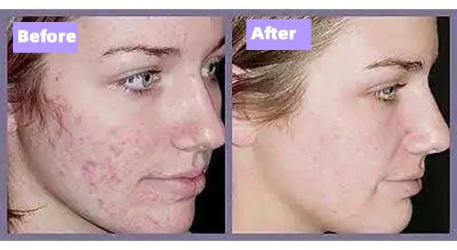 Purity - IPL & Cryotherapy Hair & Acne Removal Handset - PhysioCare