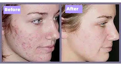 Purity - IPL & Cryotherapy Hair & Acne Removal Handset - PhysioCare