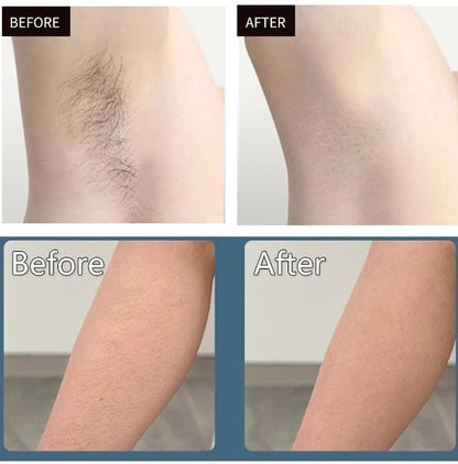 Purity - IPL & Cryotherapy Hair & Acne Removal Handset - PhysioCare