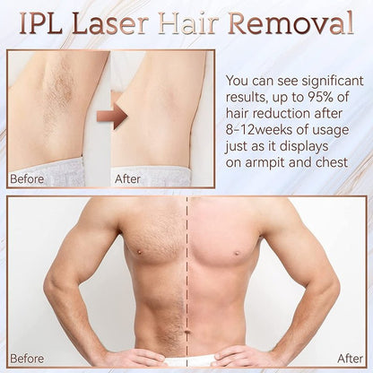 Purity - IPL & Cryotherapy Hair Removal Handset - PhysioCare
