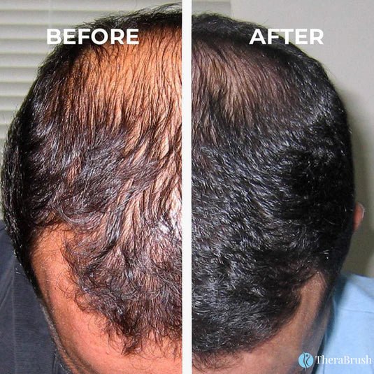 TheraBrush®- Premium Hair Growth Brush - PhysioCare